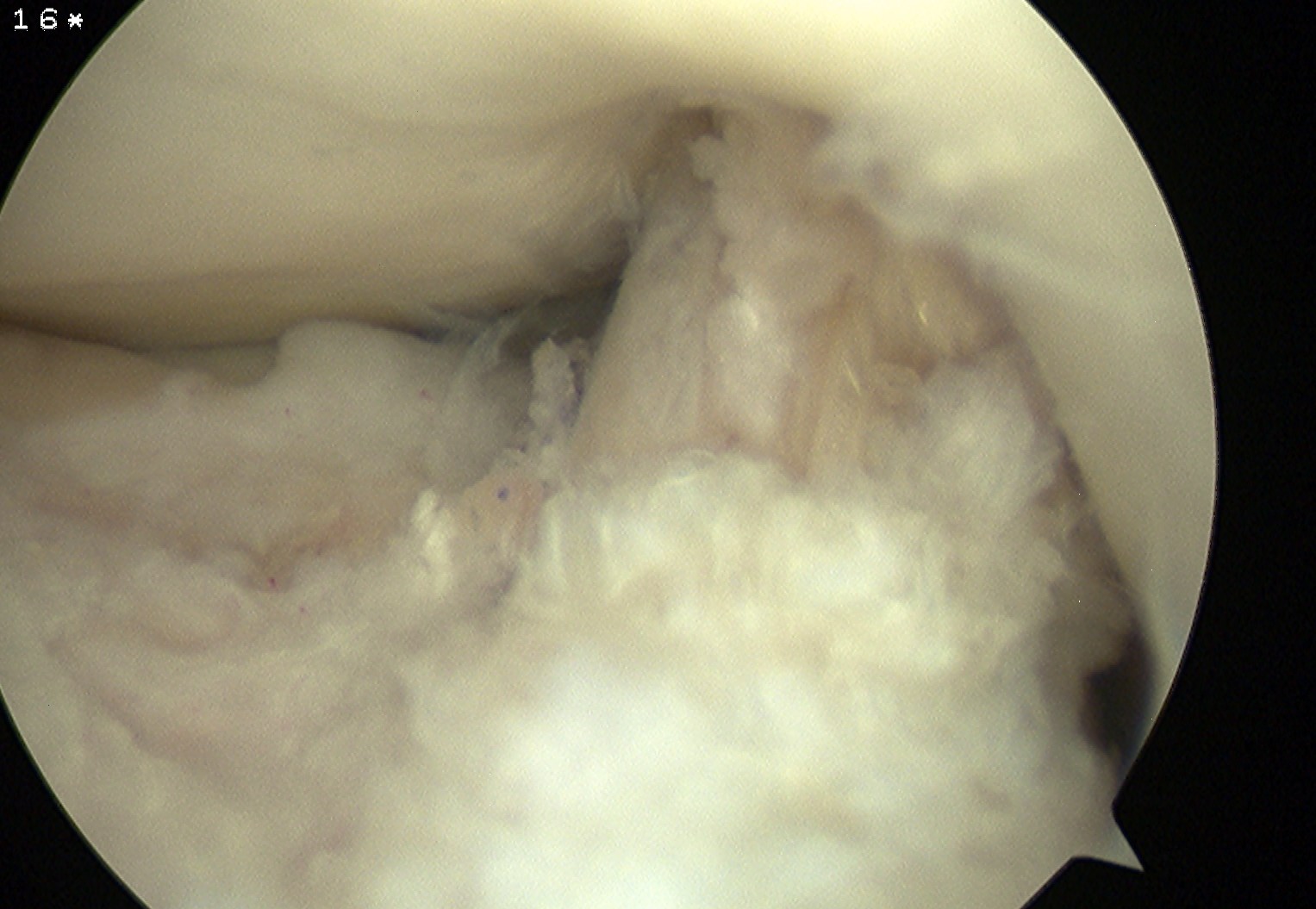 ACL Reconstruction No Anterior Graft Impingement in Full Extension